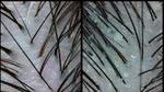 Feature image - How dandruff affects your scalp